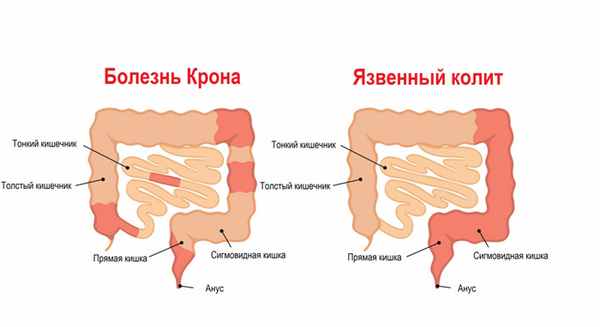 Болезнь Крона и колит.jpg