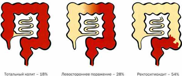 Частота и распространение воспаления в толстой кишке