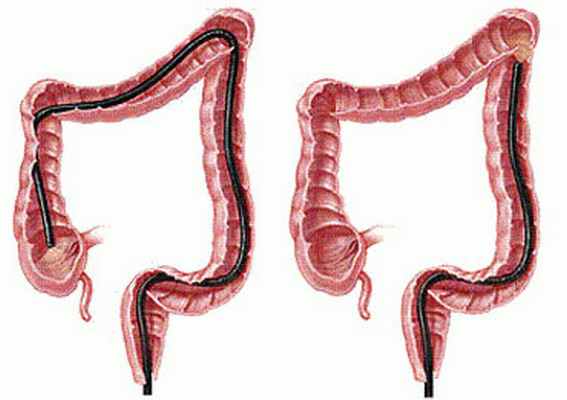 Схема продвижения колоноскопа в толстой кишке