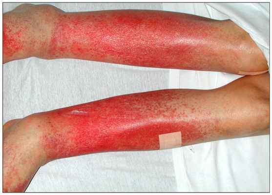 Пигментный прогрессирующий дерматоз Шамберга