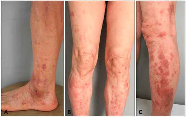 Гемосидероз - Дерматит Гужеро-Блюма