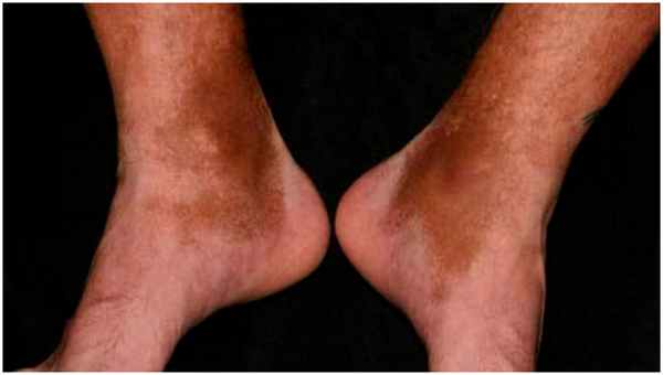 Посттравматический гемосидероз на ногах