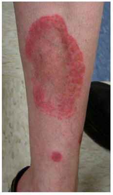 Гемосидероз - кольцевидная телеангиэктатическая пурпура Майокки