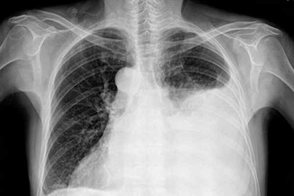 Гемоторакс