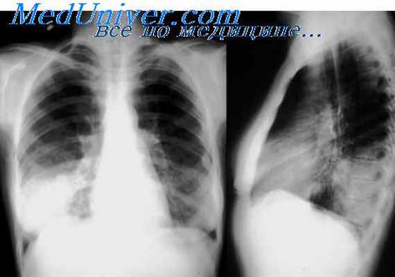 генетическая бронхиальная астма