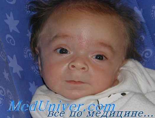 генетика мукополисахаридозов