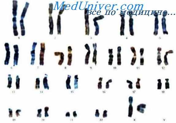 несовершенный остеогенез