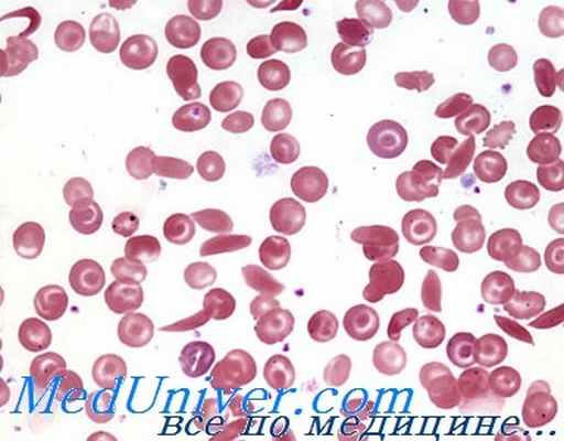 серповидноклеточная анемия