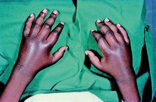 Серповидно-клеточная анемия