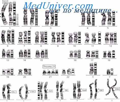 генетика синдрома Дауна