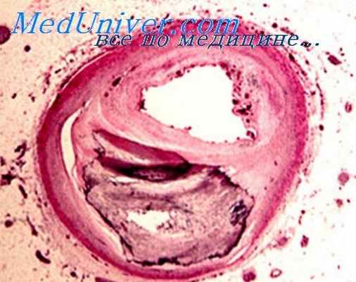 ксимелагатран