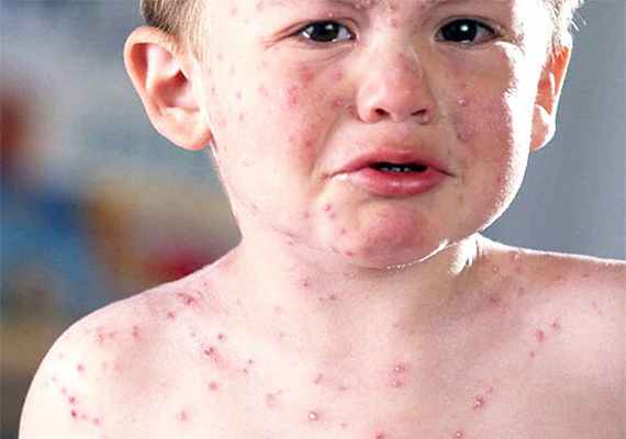 Сыпь на теле ребенка, больного ветрянкой