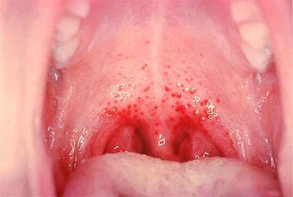 Сыпь в горле