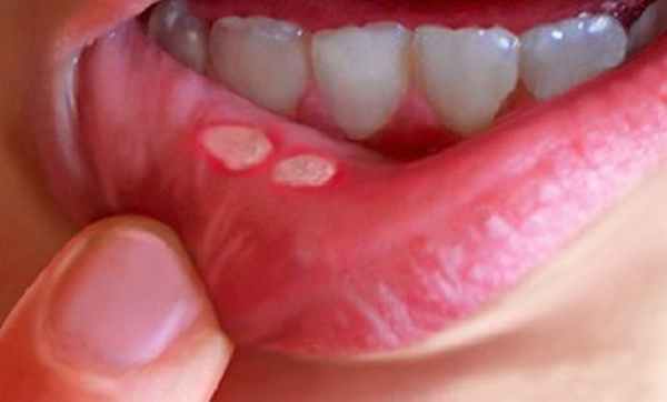 Stomatitis1