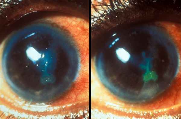 Герпетический кератит