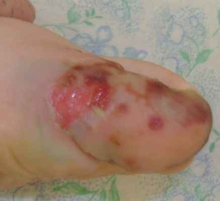 Герпетический панариций