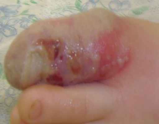 Герпетический панариций