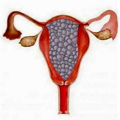 трофобластическая болезнь