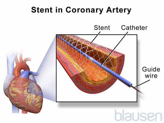 Обзор ишемической болезни сердца (Overview of Coronary Artery Disease)