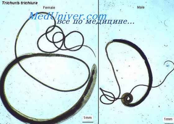 трихоцефаллез