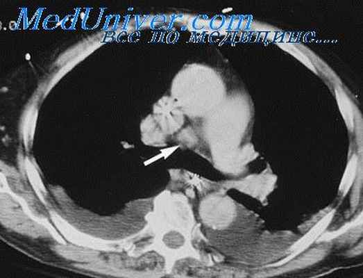 эхинококк средостения