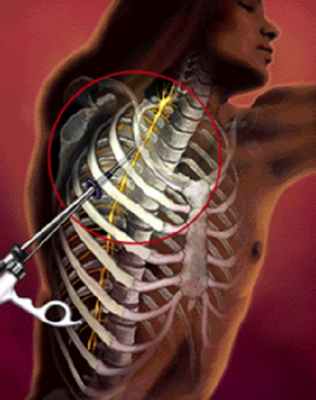 лечение гипергидроза