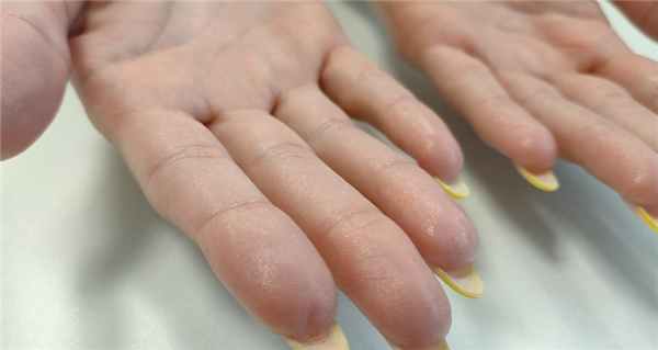 Лечение потливости ладоней и подмышек в Краснодаре