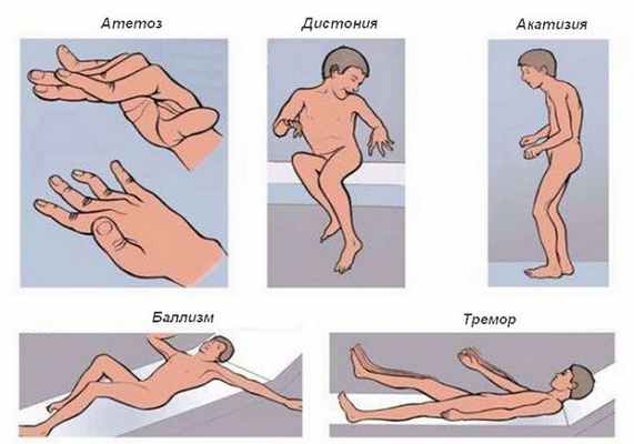 Гиперкинезы – формы, причины, симптомы и лечение - фото