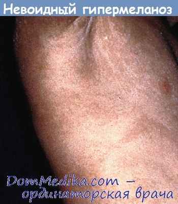 Линейный и зивитой невоидный гипермеланоз