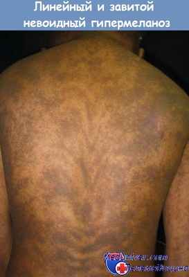 Линейный и зивитой невоидный гипермеланоз