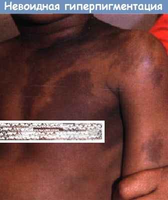 Невоидная гиперпигментация