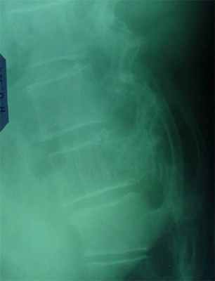 Новообразования костей11.jpg