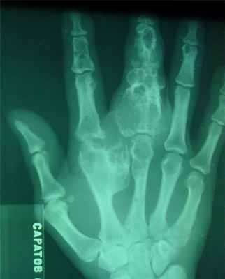 Новообразования костей6.jpg