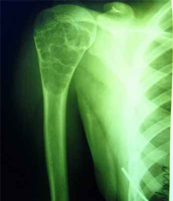 Новообразования костей8.jpg