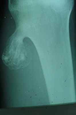 Новообразования костей4.jpg