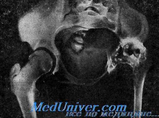 деструкция кости