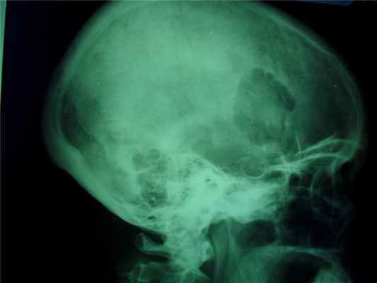 Новообразования костей10.jpg