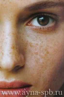 пигментные пятна