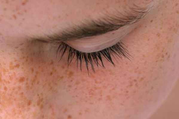 Удаление пигментации