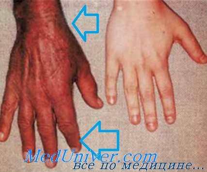 Гемохроматоз