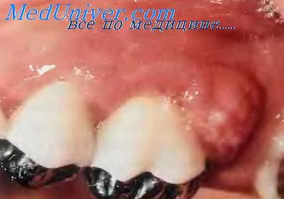 гингивит у больного