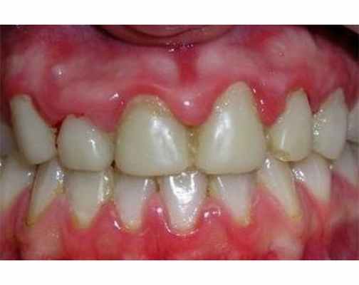 Гиперплазия десен