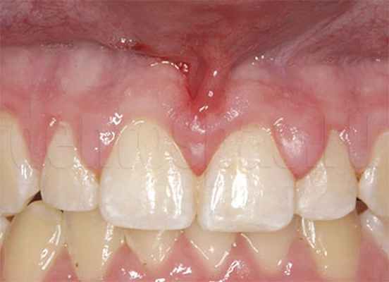 Гиперплазия верхней десны