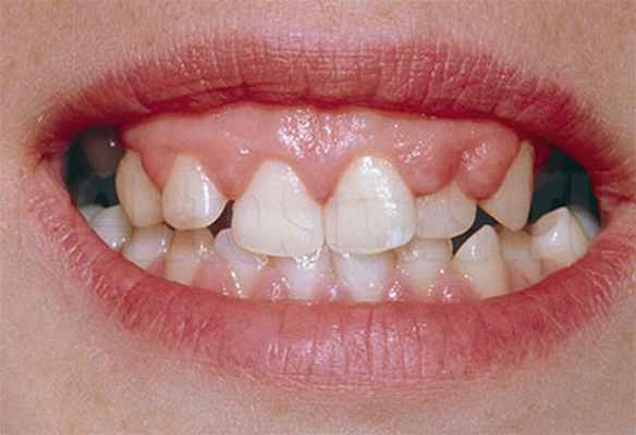 Гиперплазия десны