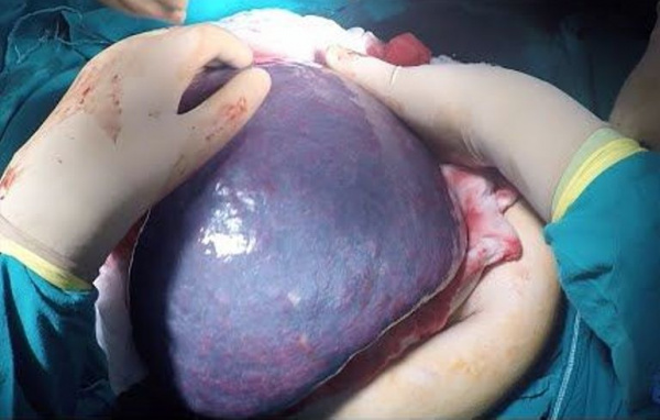 Открытая спленэктомия у пациента со спленомегалией и гиперспленизмом