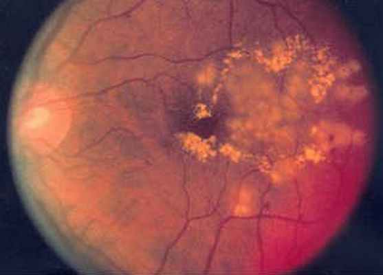 Гипертоническая ретинопатия сетчатки глаза