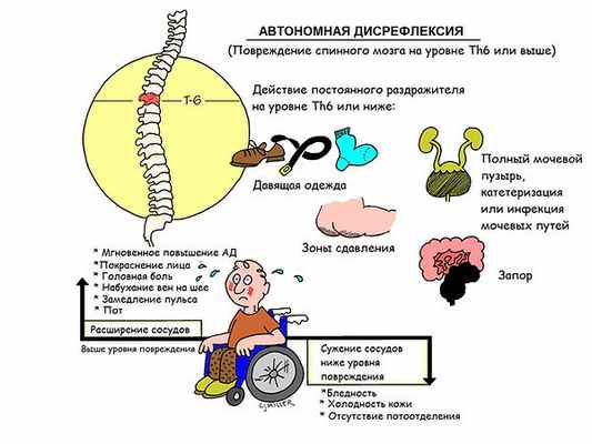 автономная дисрефлексия