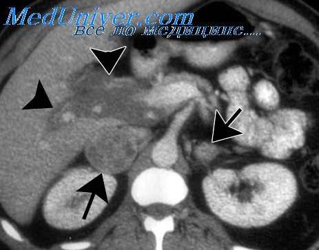 феохромоцитома