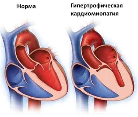 Гипертрофическая кардиомиопатия