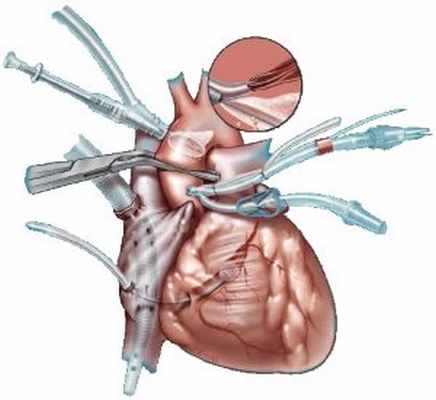 Резекция межжелудочковой перегородки